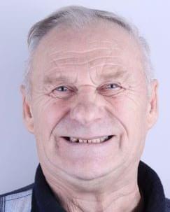 До имплантации